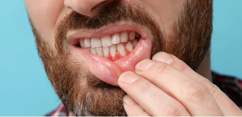 Advanced gum disease